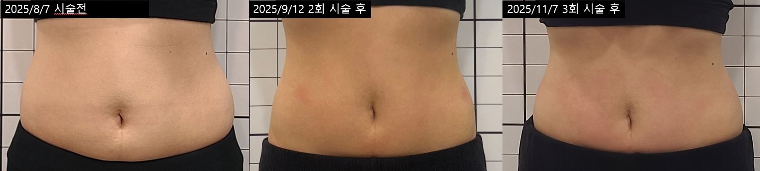 복부 관리 경과