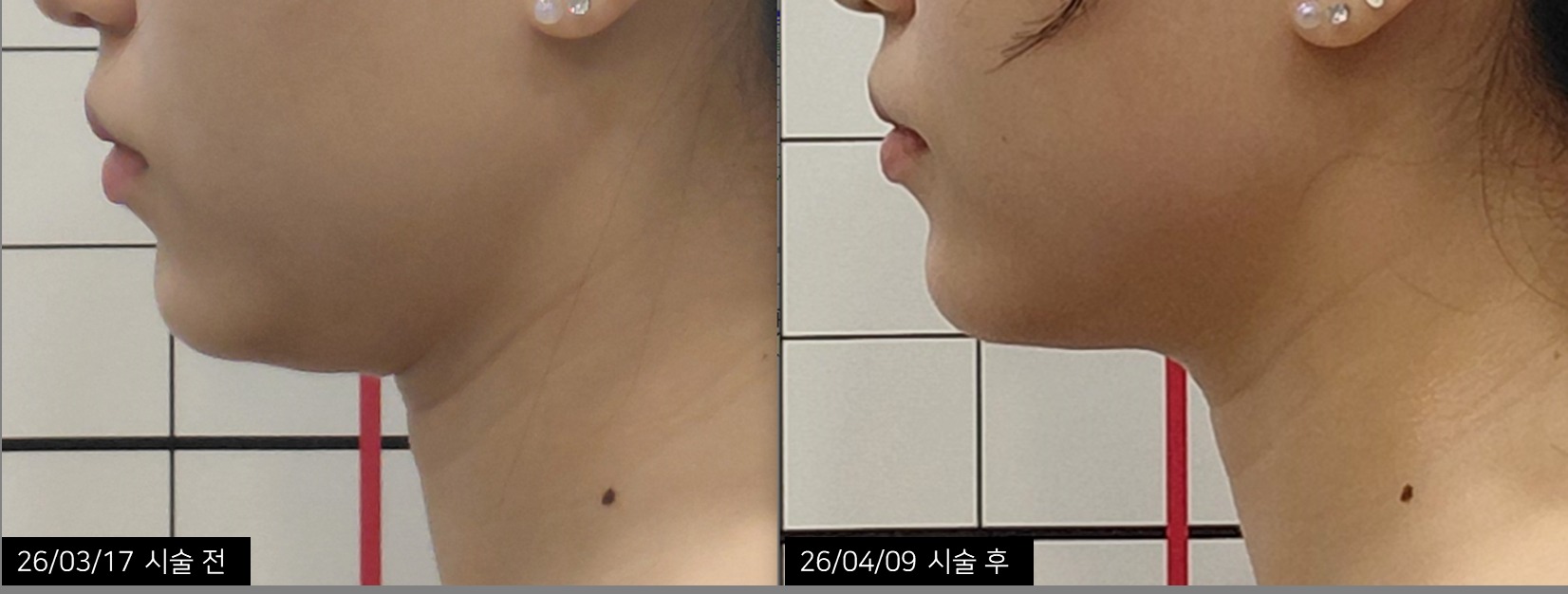 턱선 시술 전후